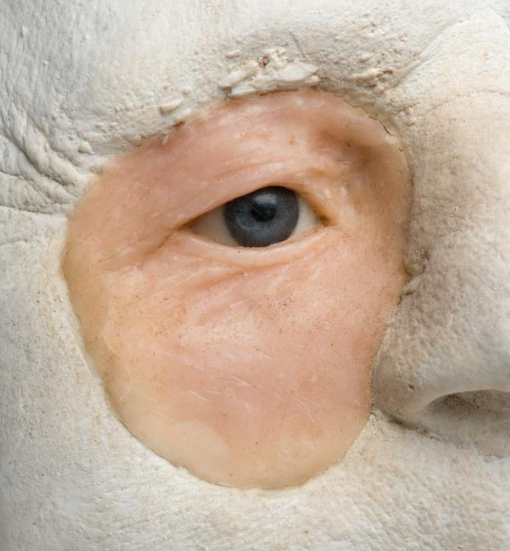 Gipsafgietsel van het gelaat van een man met een oogprothese